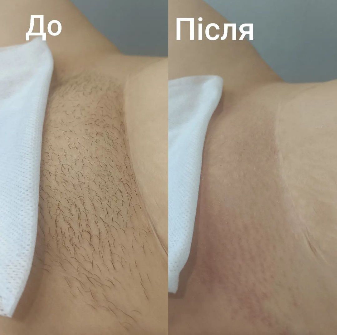 Воскова депіляція. Депіляція воском. Черемушки.