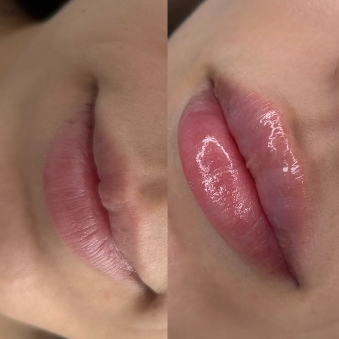 Косметолог інʼєкціоніст (губи 4000/ботокс/біоревіталізація)