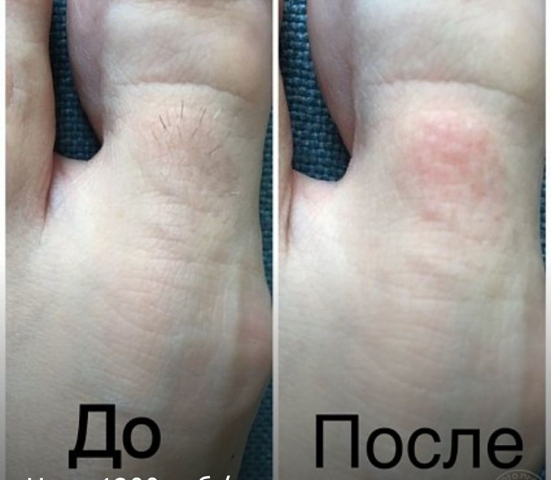 Електроепіляція на Виноградарі