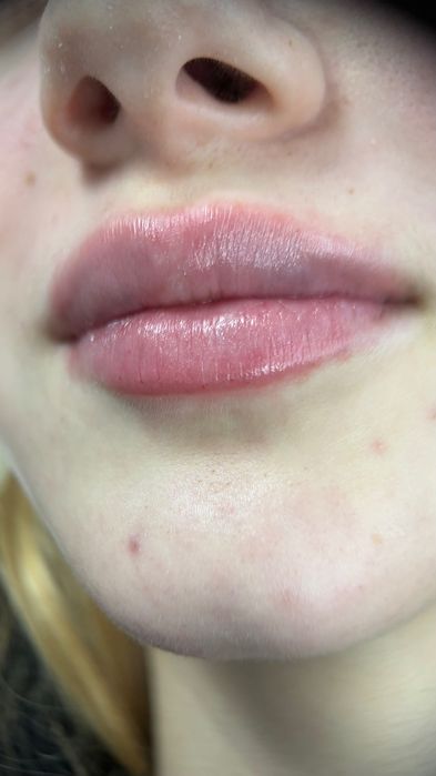 Безкоштовно збільшення губ / контурна пластика губ / ботокс