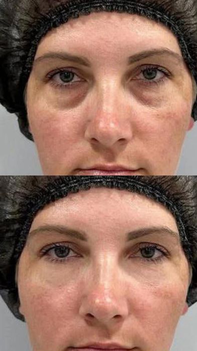 Косметолог- Дерматолог.Ботокс.Контурная пластика. Чистка лица. Массаж