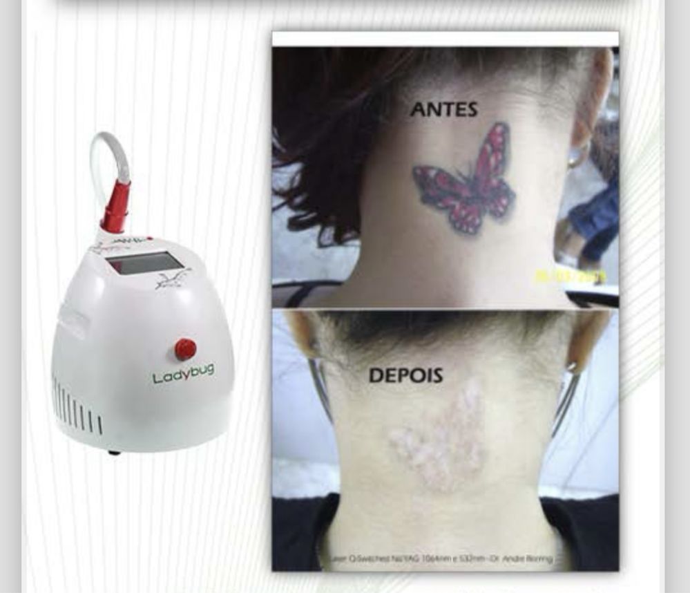 Aluguel máquina de remocao de tatuagem.