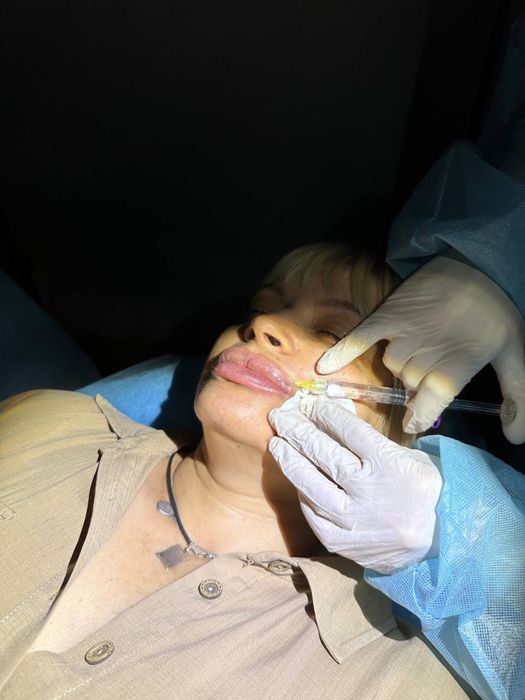 Увеличение губ , ботокс. Чистка лица