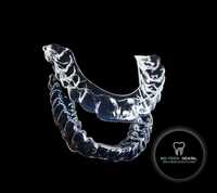 Indywidualne nakładki wybielające zęby