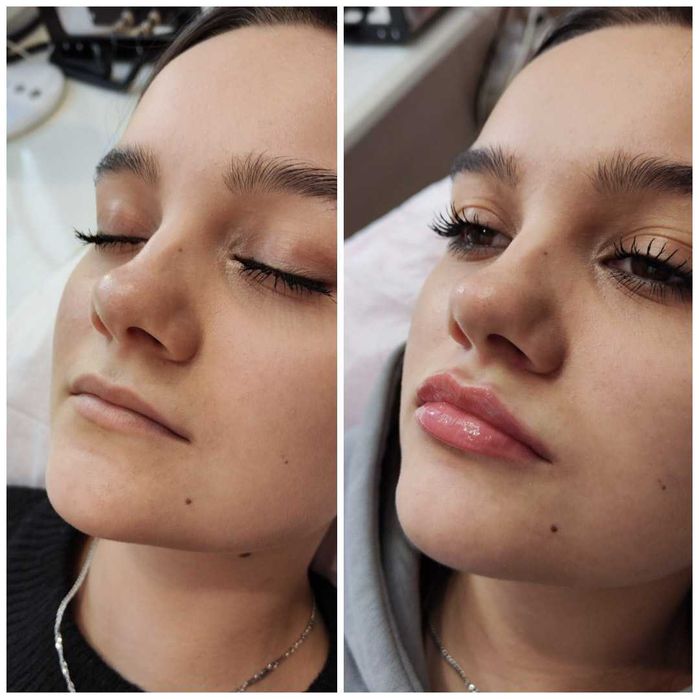 Увеличение губ, контурная коррекция