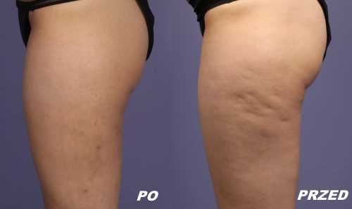 Pogromca cellulitu Olej z bluszczu na cellulit 100 ml