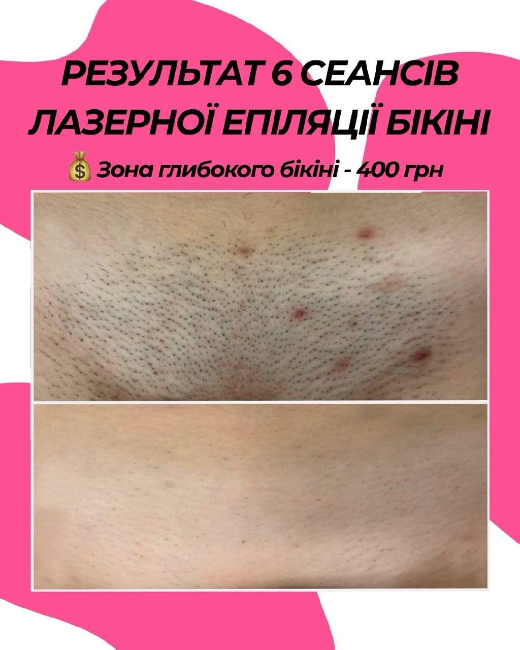 Лазерна епіляція з гарантією результату