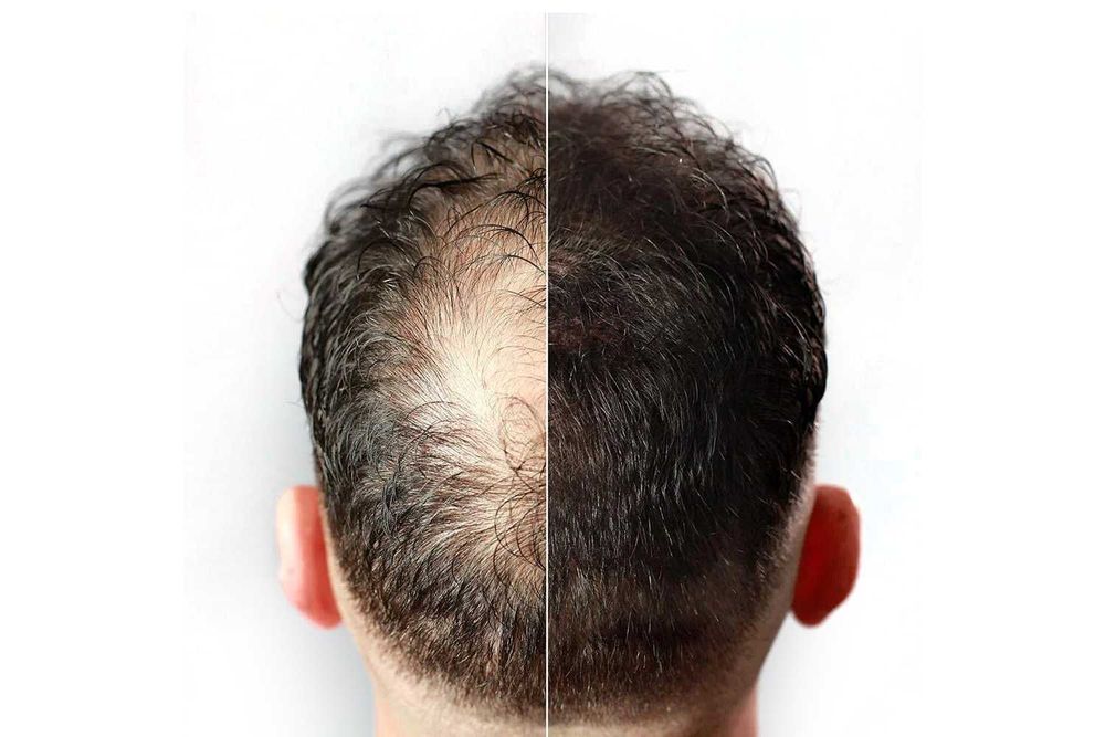 Fibras capilares | densidade para perda de cabelo | Calvície