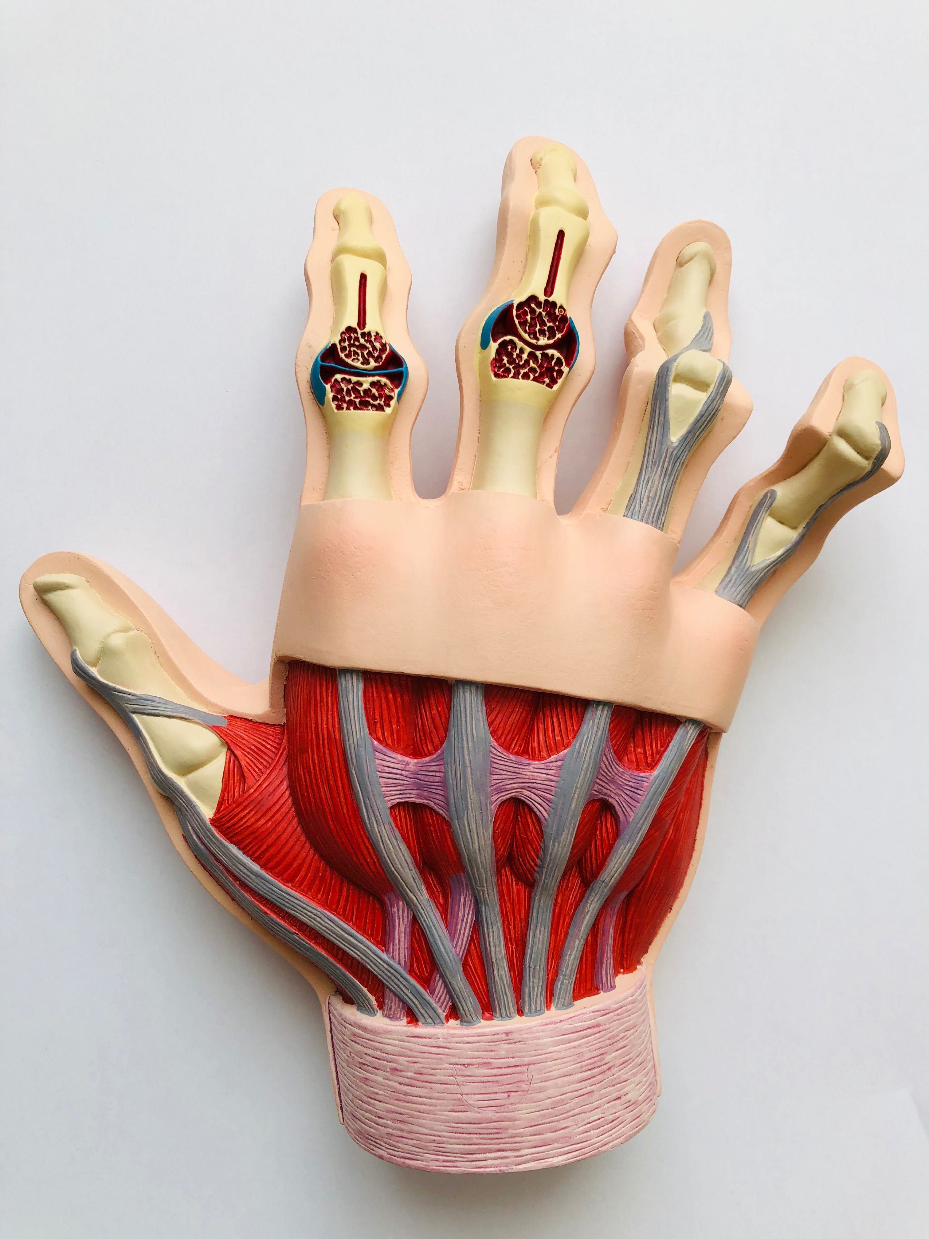 Model ręki z reumatoidalnym zapaleniem stawów