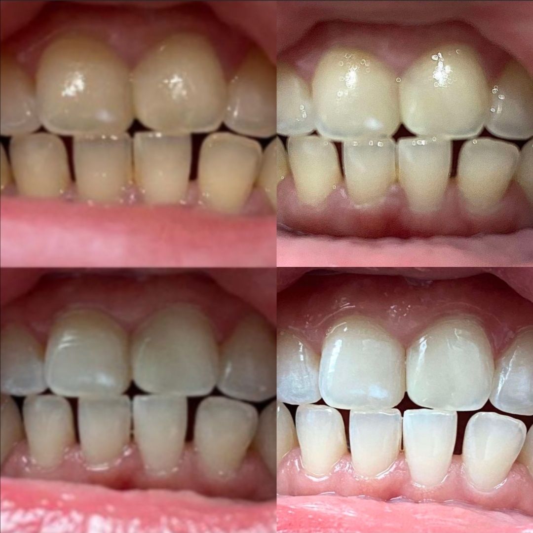Профессиональная чистка зубов и отбеливание со скидкой.