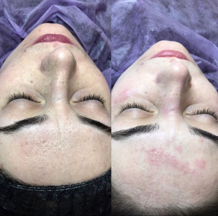 Чистка лица | центр