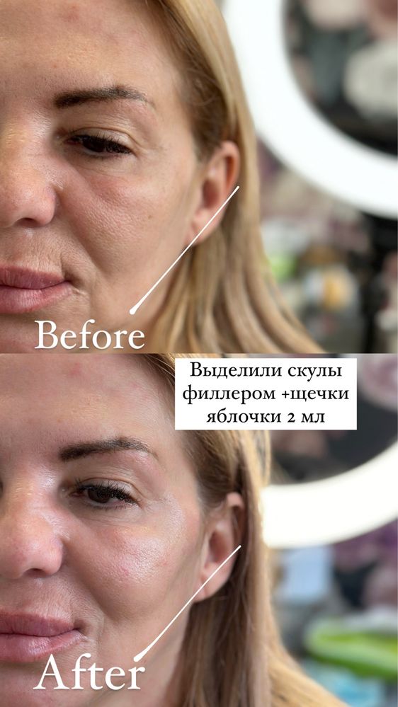 Косметолог/Кривой Рог/Увеличение губ/Ботокс