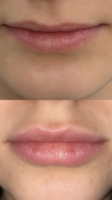 Шукаю моделей на контурну пластику губ,препарати тільки сертифіковані