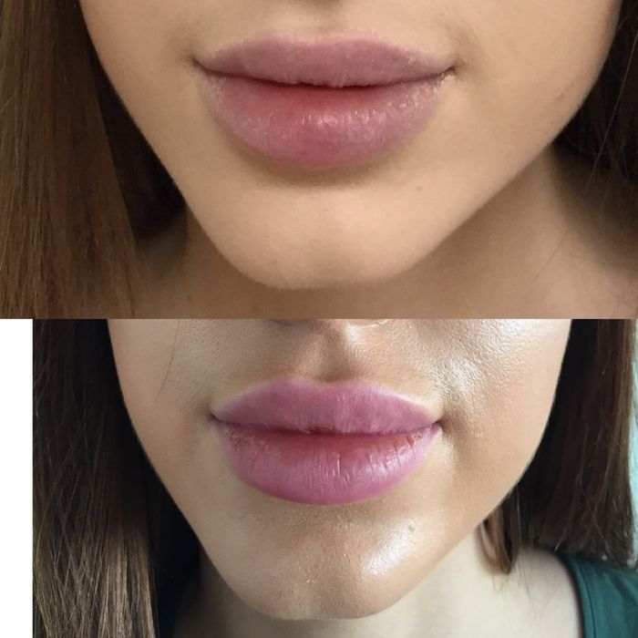 Губи та Ботокс  Новорічні знижки !!!