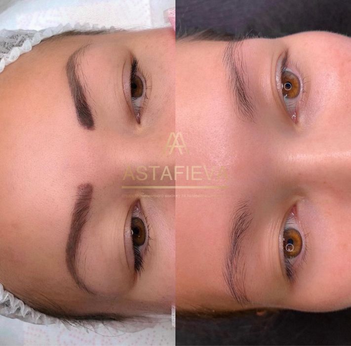 Скидка на безопасное Лазерное удаление тату/татуажа карбоновый пилинг