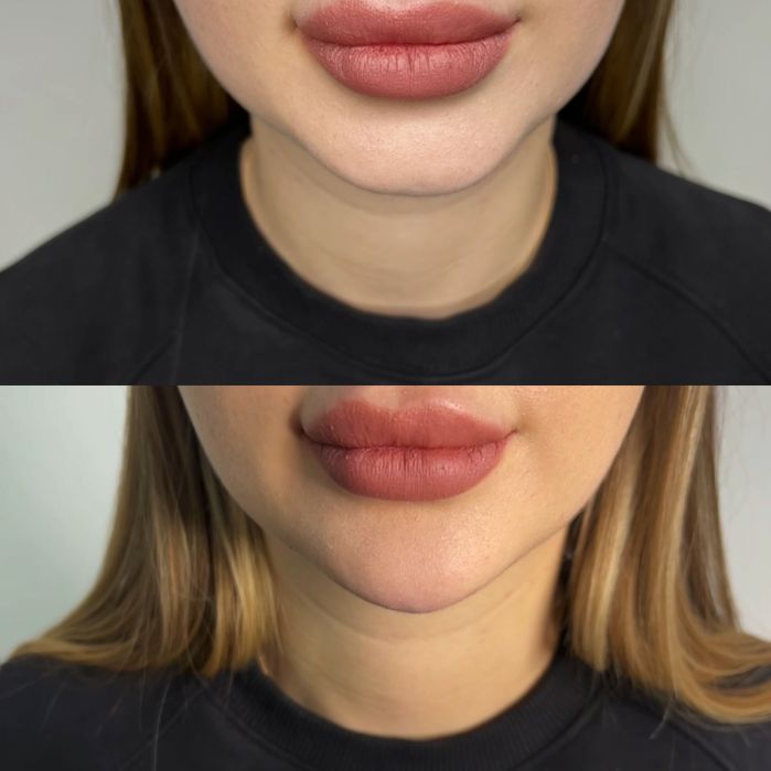 Модель на губы  ботокс Угли Джоли скули