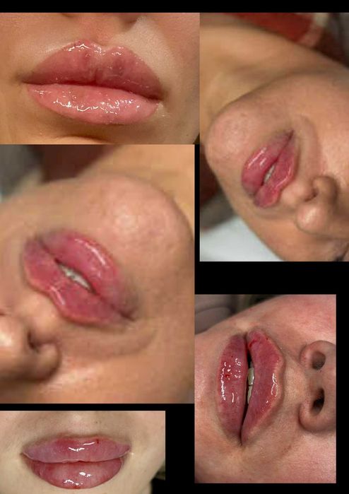 Pełne, zmysłowe USTA - spełnij swoje marzenia!