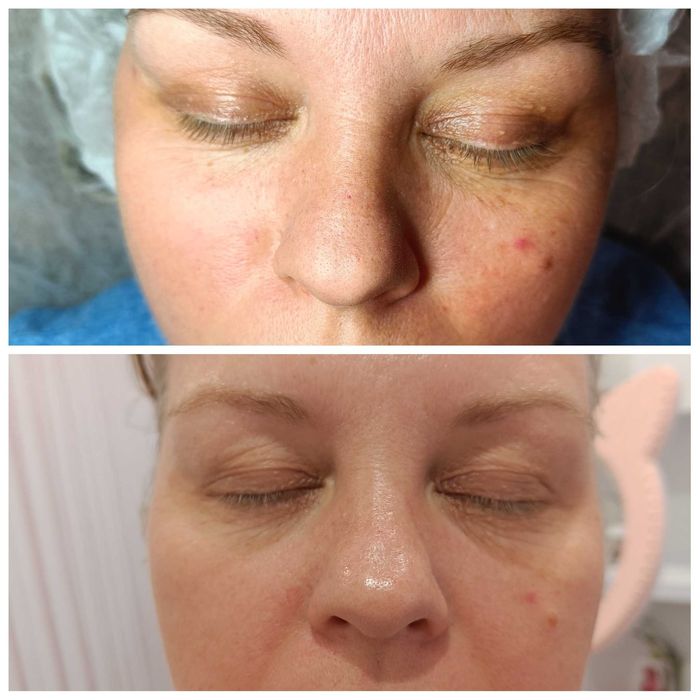 Опытный косметолог | Чистки, пилинги, инъекции