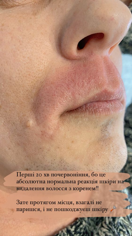Чоловіча, жіноча депіляція, шугаринг, Миколаїв.