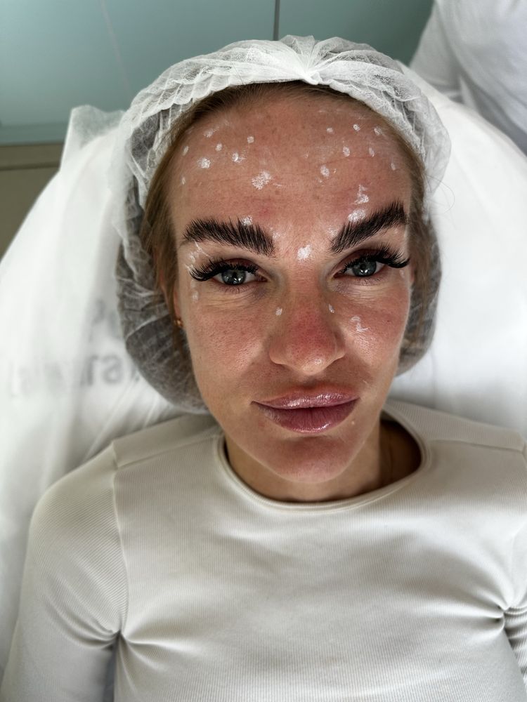 Акція збільшення губ , Botox