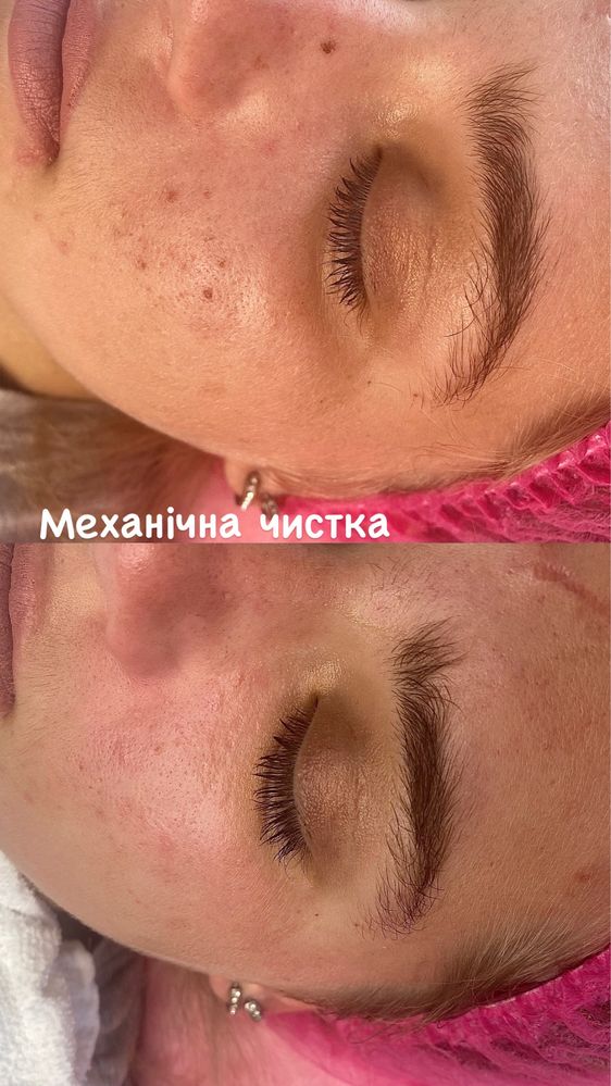 Косметолог з медичною освітою. Миргород. Губи. Ботокс. Чистка обличчя.