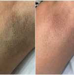 Depilacja laserowa Promocyjne ceny Laser diodowy