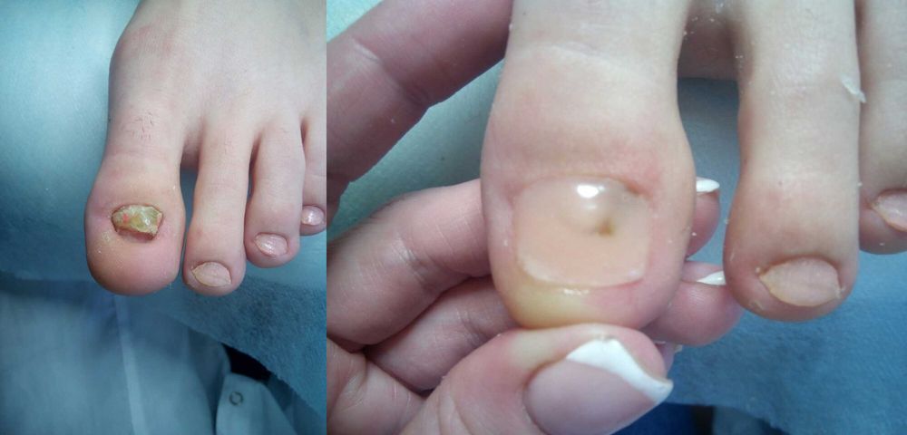 Подолог с Выездом на Дом для стариков,вросший ноготь,грибок,Медпедикюр