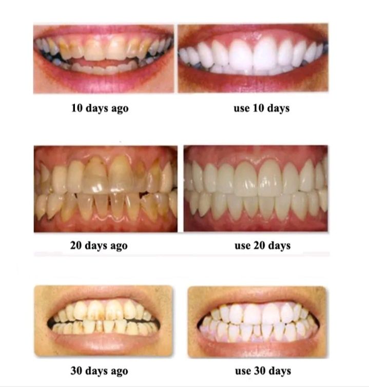 Оригинальные полоски для отбеливания зубов 7 пакетиков - 14 полосок