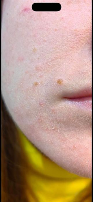 Дерматолог. Консультация онлайн