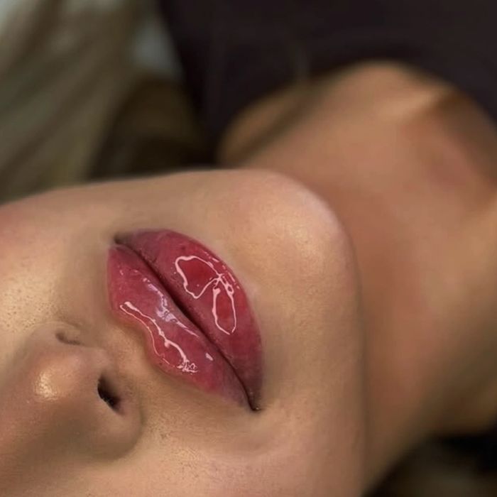 Usta 1ml od 300zł wypełniacz Premium, stymulatory, btx