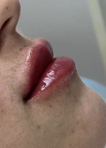 Увеличение губ , ботокс. Чистка лица