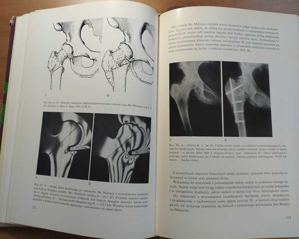 Ortopedia Garlicki Kreczko arthrosis deformans coxae
