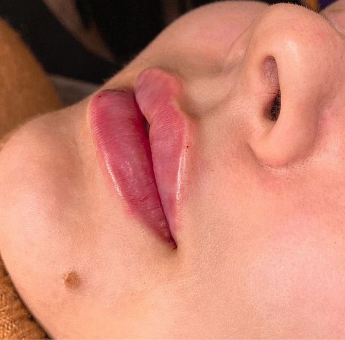 Косметолог. Увеличения Губ. Углы Джоли , скулы , Подбородок. Ботокс .