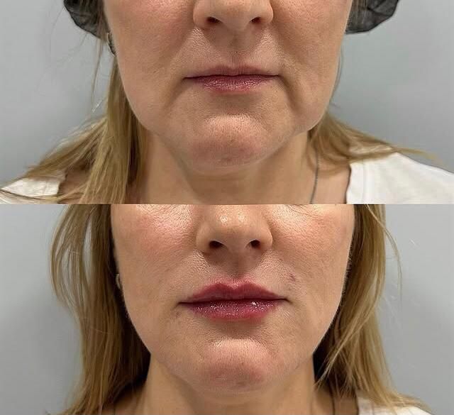 Косметолог- Дерматолог.Ботокс.Контурная пластика. Чистка лица. Массаж