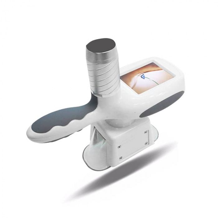 Criolipolise , lipolaser, cavitação, radiofrequência