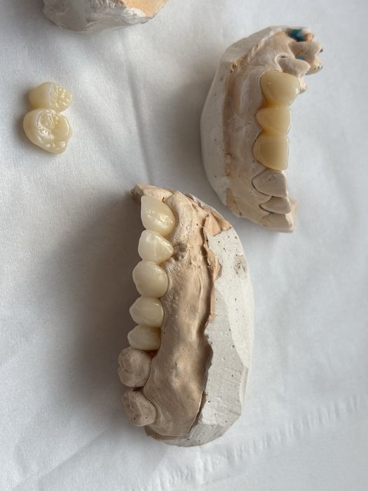 Зубний технік цирконіва коронка 1000