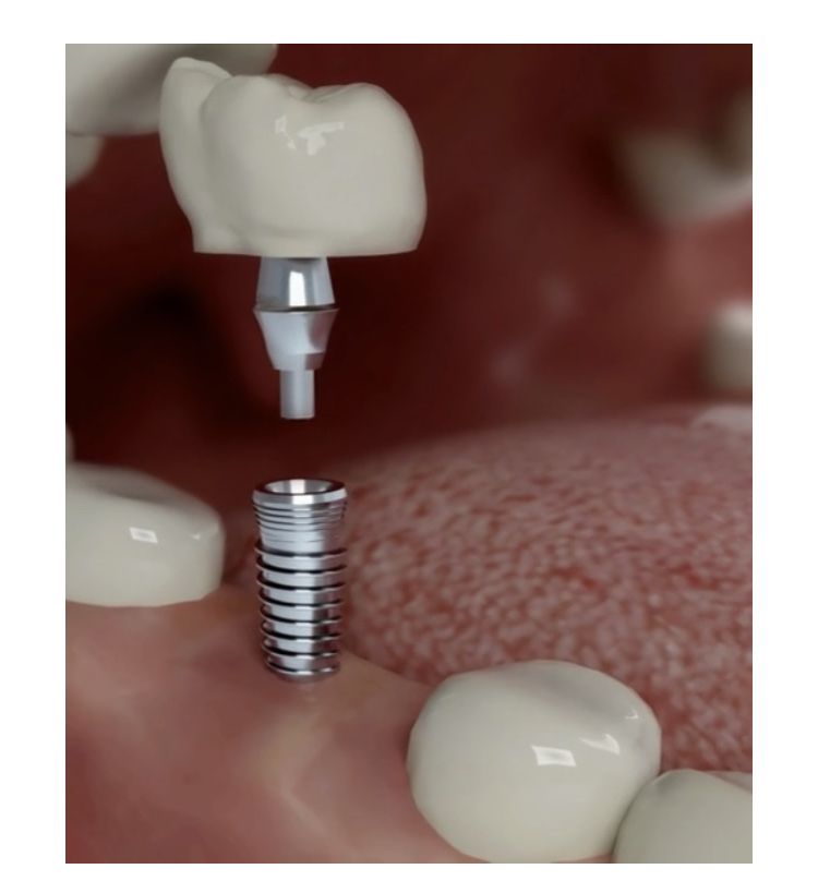 IMPLANTES DE DENTES   em várias tranches        varios pagamentos um  sorriso e expressao facial de excelência