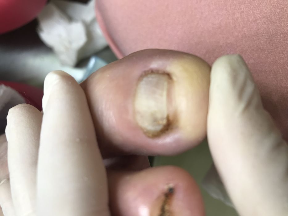 Pedicure medical domiciliar