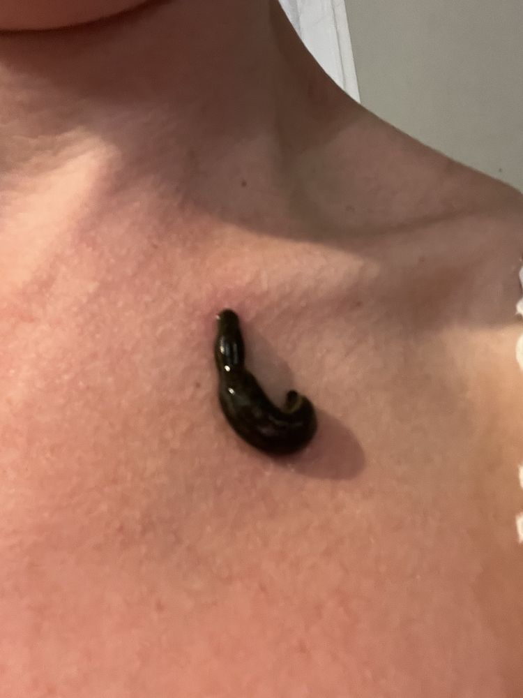 Terapia pijawkami hirudoterapia