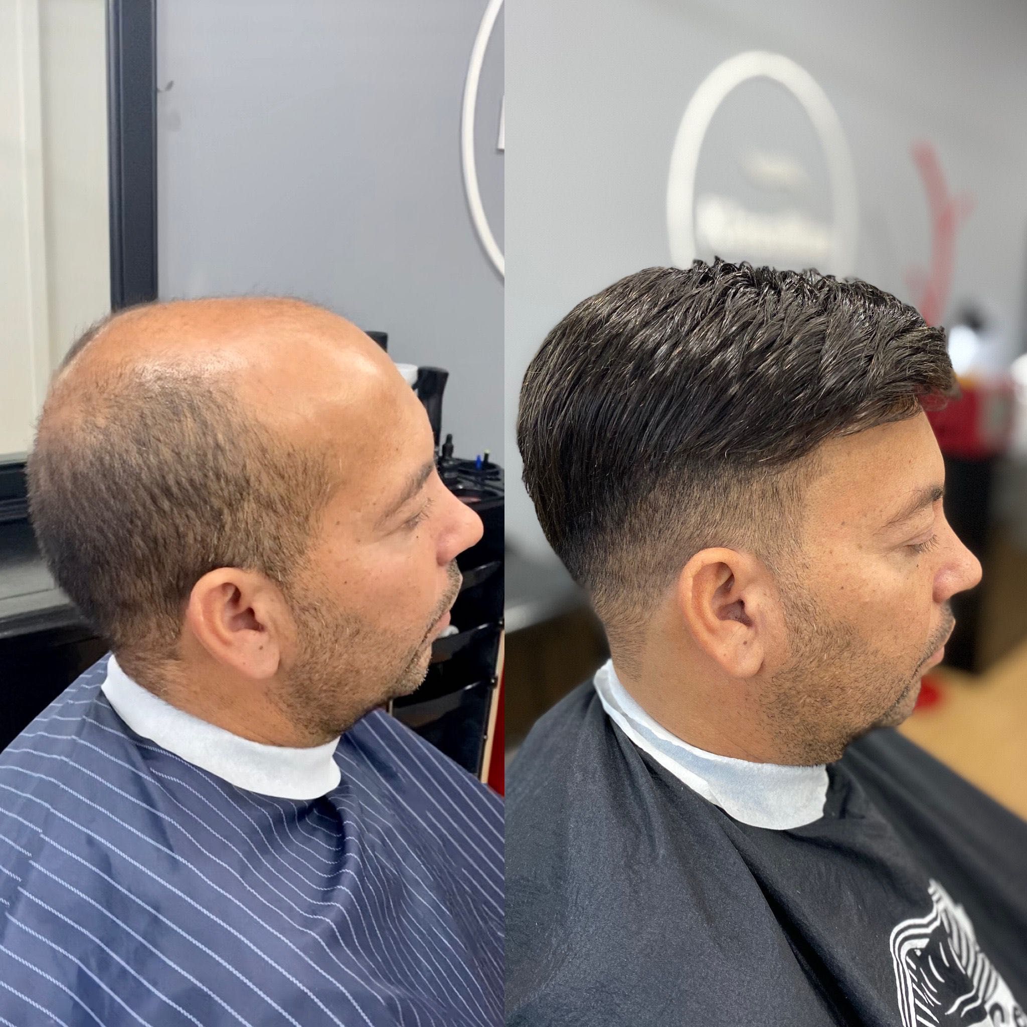 Prótese Capilar HD = Cabelo em 2h!  Clinica KlassMan Lisboa e Porto