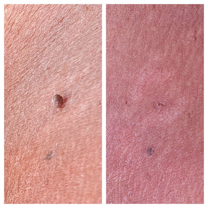 remoção de verrugas e rejuvenecimiento!