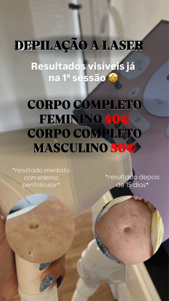 Depilaçao A Laser