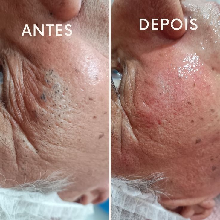 Limpeza de Pele Malveira