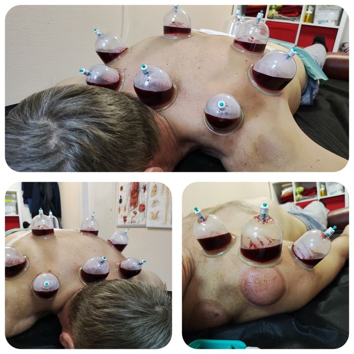 Хиджама лечебная, профилактическая в Киеве,  м. Левобережная.