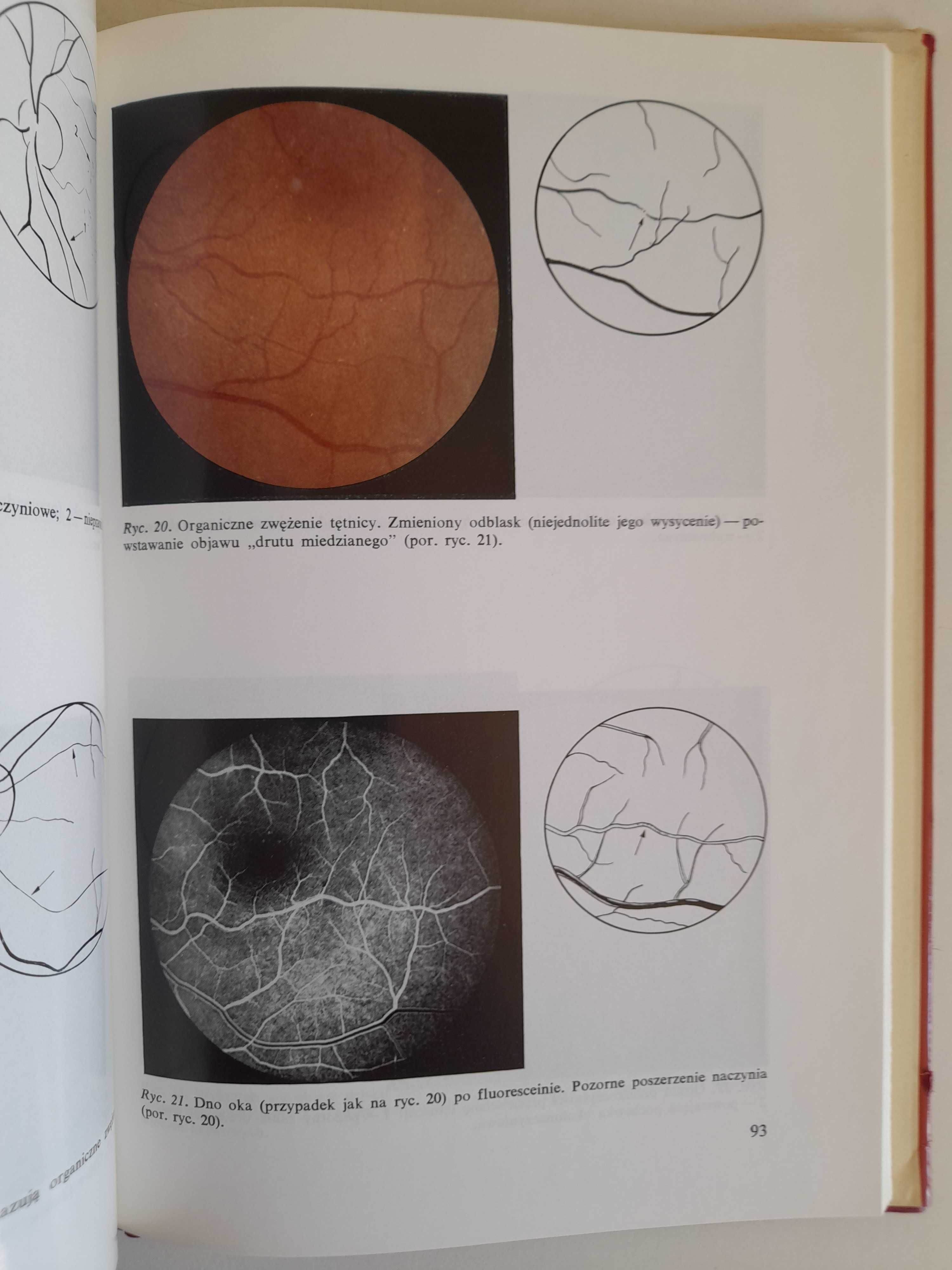 Dno oka w nadciśnieniu tętniczym - Edward BRYK
