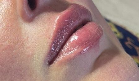 Контурна пластика губ від 3000 ботокс 1000