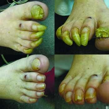 Подолог с Выездом на Дом для стариков,вросший ноготь,грибок,Медпедикюр