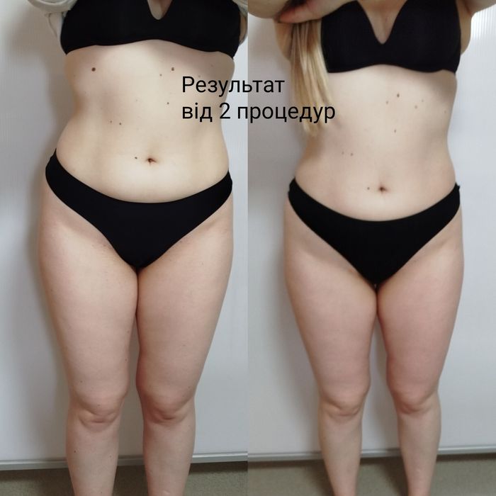 Антицелюлiтний, класичний масаж