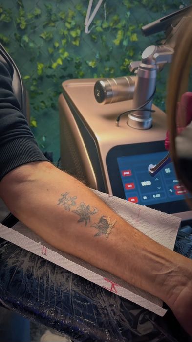 Laserowe Usuwanie Tatuażu i Makijażu Permanentnego - Studio Knurów