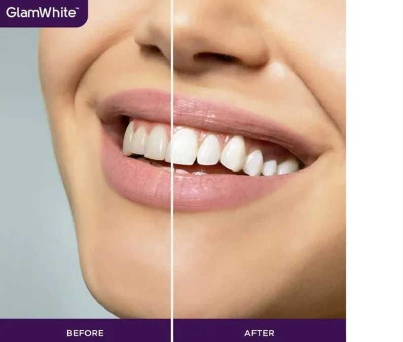 Kit de Branqueamento Dentário GLAMWHITE Elite